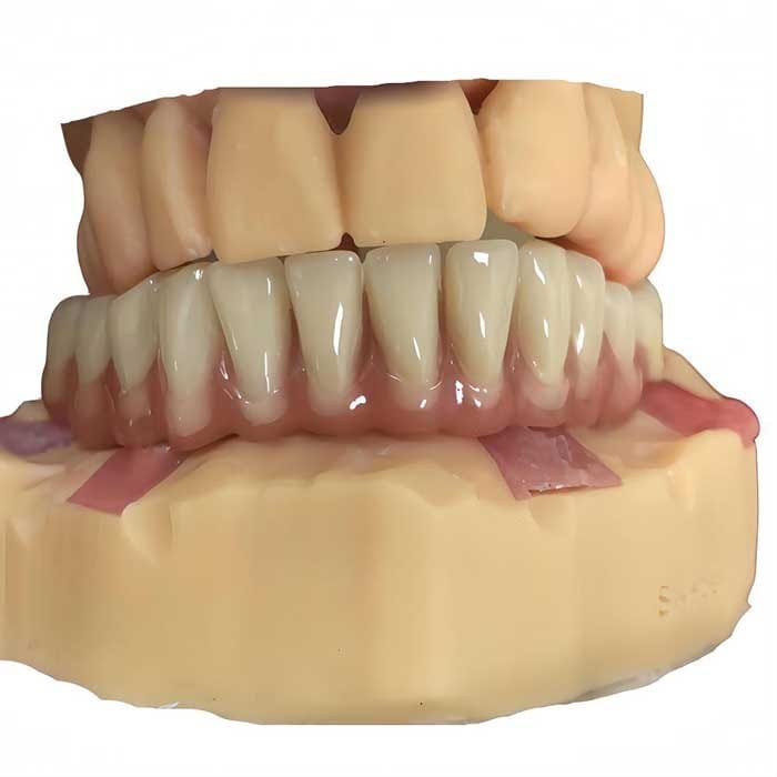 Full Acrylic implant all on 1