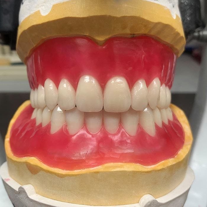 acrylic denture 4