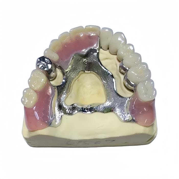 casted metal partial 1 casted metal partial 1