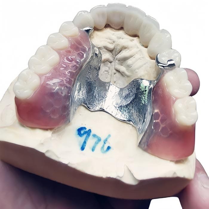 casted metal partial 2 casted metal partial 2