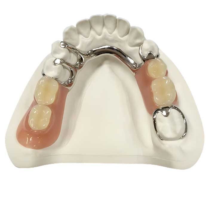 casted metal partial 3 casted metal partial 3