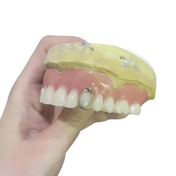 casted metal partial 4 casted metal partial 4