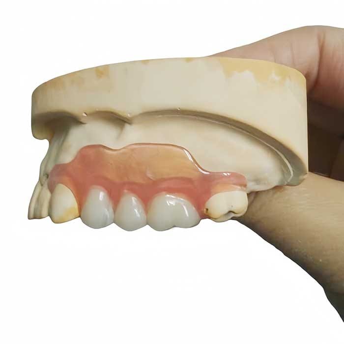 flexible denture 3 flexible denture 3