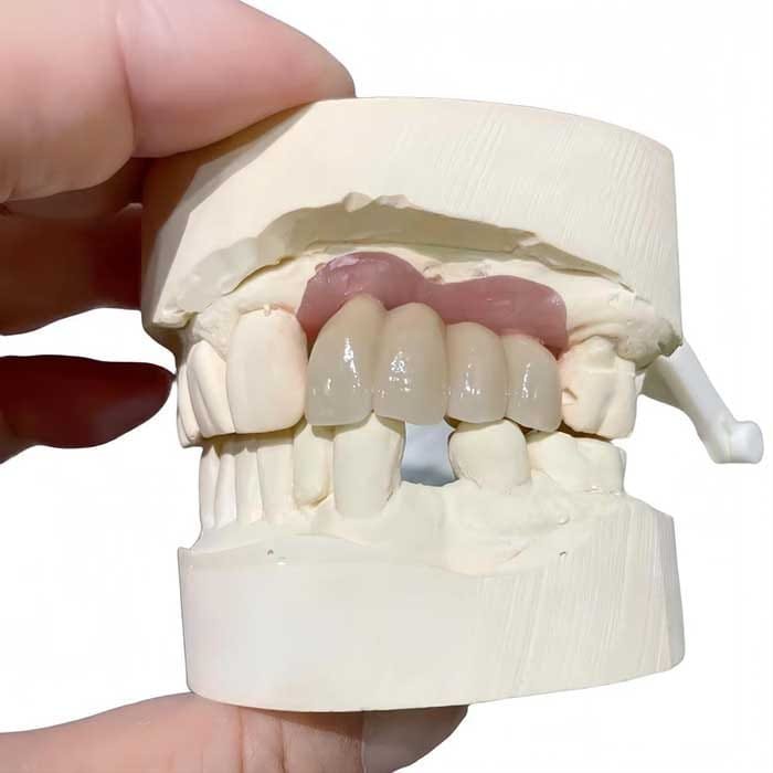 implant crown 1 implant crown 1