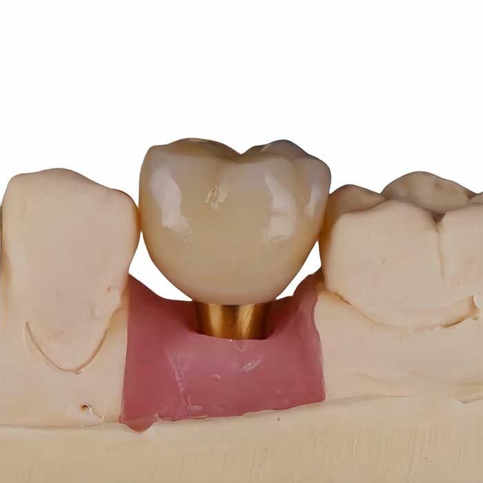 implant crown 4 implant crown 4