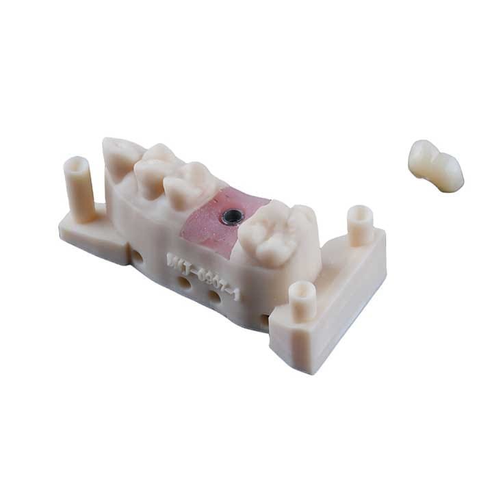 implant crown 5 implant crown 5