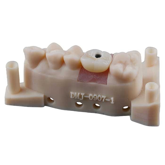 implant crown 6 implant crown 6