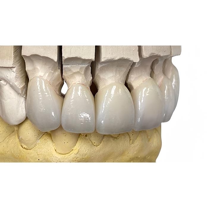 layered zirconia 4 Layered zirconia 4
