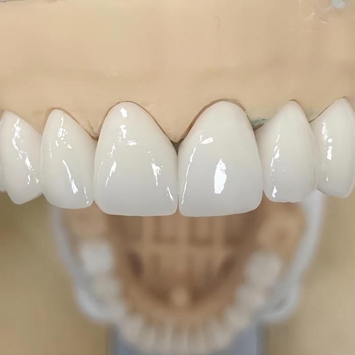 layered zirconia 6