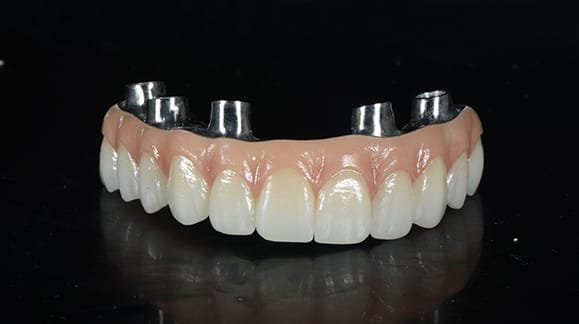 full-arch-implant-prosthesis