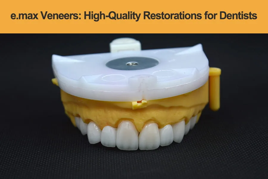 e.max-Veneers---High-Quality-Restorations