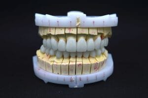 emax-veneers1