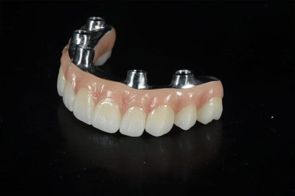 Acrylic-Implants