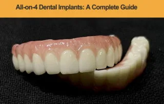 All-on-4-Dental-Implants-A-Complete-Guide