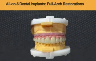 All-on-6-Dental-Implants---Full-Arch-Restorations-by-SF-Dental-Lab