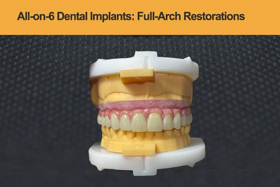All-on-6-Dental-Implants---Full-Arch-Restorations-by-SF-Dental-Lab