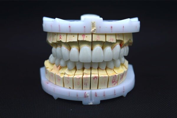 Zirconia-Veneers-02