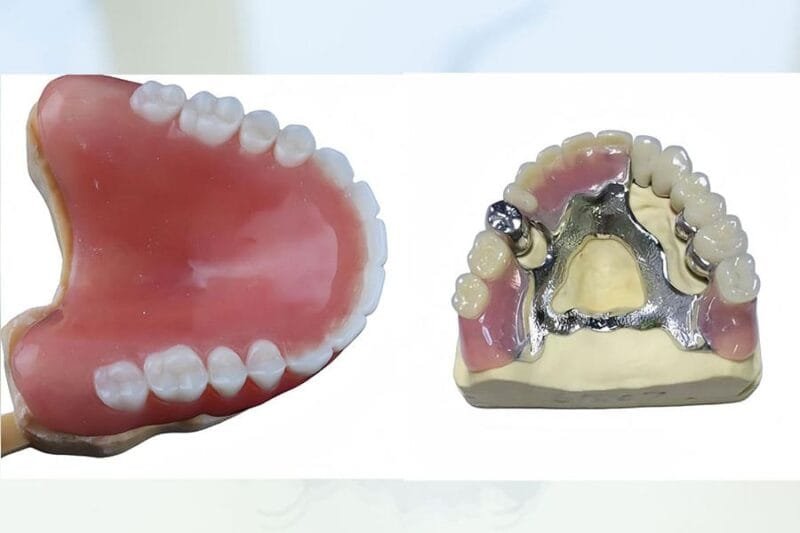 Acrylic Dentures Partial: Types, Benefits & Lab Guide