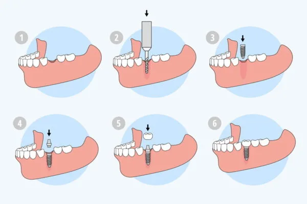 Dental-Implant-Parts-by-Treatment-Stage