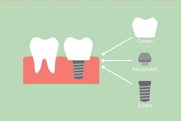 What-Are-Dental-Implant-Parts