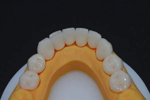 Zirconia-Crowns