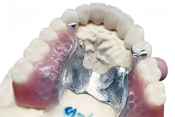 casted-metal-partial