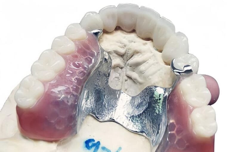 Metal Dental Partials: Materials, Benefits, and Lab Guide